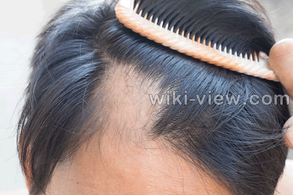 ریزش مو, علت ریزش مو, جلوگیری ریزش مو, ریزش مو شدید, علت ناگهانی ریزش مو, درمان ریزش مو مردان, درمان ریزش مو با آب پیاز, درمان سنتی ریزش مو, قرص جلوگیری از ریزش مو, برای جلوگیری از ریزش مو چه بخوریم ریزش مو, علت ریزش مو, جلوگیری ریزش مو, ریزش مو شدید, علت ناگهانی ریزش مو, درمان ریزش مو مردان, درمان ریزش مو با آب پیاز, درمان سنتی ریزش مو, قرص جلوگیری از ریزش مو, برای جلوگیری از ریزش مو چه بخوریم