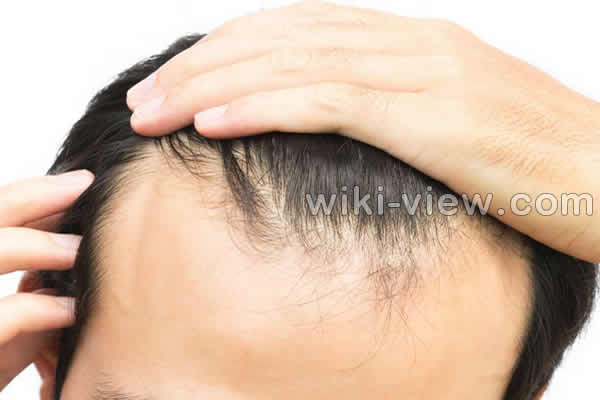 ریزش مو, علت ریزش مو, جلوگیری ریزش مو, ریزش مو شدید, علت ناگهانی ریزش مو, درمان ریزش مو مردان, درمان ریزش مو با آب پیاز, درمان سنتی ریزش مو, قرص جلوگیری از ریزش مو, برای جلوگیری از ریزش مو چه بخوریم ریزش مو, علت ریزش مو, جلوگیری ریزش مو, ریزش مو شدید, علت ناگهانی ریزش مو, درمان ریزش مو مردان, درمان ریزش مو با آب پیاز, درمان سنتی ریزش مو, قرص جلوگیری از ریزش مو, برای جلوگیری از ریزش مو چه بخوریم