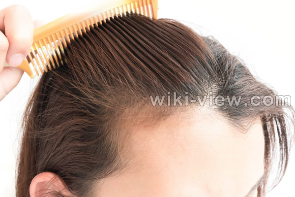 ریزش مو, علت ریزش مو, جلوگیری ریزش مو, ریزش مو شدید, علت ناگهانی ریزش مو, درمان ریزش مو مردان, درمان ریزش مو با آب پیاز, درمان سنتی ریزش مو, قرص جلوگیری از ریزش مو, برای جلوگیری از ریزش مو چه بخوریم ریزش مو, علت ریزش مو, جلوگیری ریزش مو, ریزش مو شدید, علت ناگهانی ریزش مو, درمان ریزش مو مردان, درمان ریزش مو با آب پیاز, درمان سنتی ریزش مو, قرص جلوگیری از ریزش مو, برای جلوگیری از ریزش مو چه بخوریم