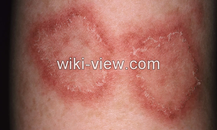 کهیر چیست, کهیر چگونه ایجاد و درمان می شود, علائم و علل کهیر پوستی, کهیر در کودکان, کهیر عصبی, شکل ظاهری کهیر, شکل ظاهری کهیر, رابطه کهیر و سرطان, درمان سریع کهیر کهیر چیست, کهیر چگونه ایجاد و درمان می شود, علائم و علل کهیر پوستی, کهیر در کودکان, کهیر عصبی, شکل ظاهری کهیر, شکل ظاهری کهیر, رابطه کهیر و سرطان, درمان سریع کهیر