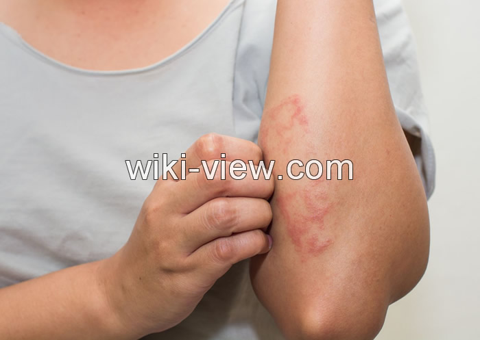 کهیر چیست, کهیر چگونه ایجاد و درمان می شود, علائم و علل کهیر پوستی, کهیر در کودکان, کهیر عصبی, شکل ظاهری کهیر, شکل ظاهری کهیر, رابطه کهیر و سرطان, درمان سریع کهیر کهیر چیست, کهیر چگونه ایجاد و درمان می شود, علائم و علل کهیر پوستی, کهیر در کودکان, کهیر عصبی, شکل ظاهری کهیر, شکل ظاهری کهیر, رابطه کهیر و سرطان, درمان سریع کهیر