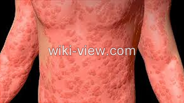 کهیر چیست, کهیر چگونه ایجاد و درمان می شود, علائم و علل کهیر پوستی, کهیر در کودکان, کهیر عصبی, شکل ظاهری کهیر, شکل ظاهری کهیر, رابطه کهیر و سرطان, درمان سریع کهیر کهیر چیست, کهیر چگونه ایجاد و درمان می شود, علائم و علل کهیر پوستی, کهیر در کودکان, کهیر عصبی, شکل ظاهری کهیر, شکل ظاهری کهیر, رابطه کهیر و سرطان, درمان سریع کهیر