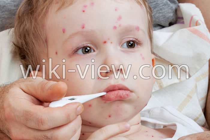 تعبیر خواب آبله, دیدن خواب آبله و آبله مرغان به چه معناست, دیدن خواب آبله مرغان, آبله در خواب به چه معناست, معنای دیدن آبله در خواب, تعبیر آبله مرغان گرفتن در خواب, تعبیر خواب بیماری آبله, تعبیر خواب بیماری آبله مرغان تعبیر خواب آبله, دیدن خواب آبله و آبله مرغان به چه معناست, دیدن خواب آبله مرغان, آبله در خواب به چه معناست, معنای دیدن آبله در خواب, تعبیر آبله مرغان گرفتن در خواب, تعبیر خواب بیماری آبله, تعبیر خواب بیماری آبله مرغان
