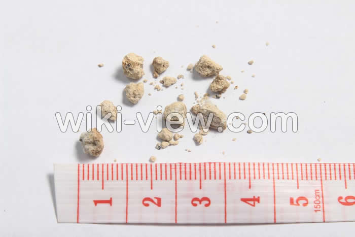 سنگ کلیه, سنگ کلیه چیست, علائم دقیق سنگ کلیه, انواع سنگ کلیه, اندازه سنگ کلیه, قرص دفع سنگ کلیه, علائم دفع سنگ کلیه, راه خانگی دفع سنگ کلیه, درمان سنگ کلیه بزرگ سنگ کلیه, سنگ کلیه چیست, علائم دقیق سنگ کلیه, انواع سنگ کلیه, اندازه سنگ کلیه, قرص دفع سنگ کلیه, علائم دفع سنگ کلیه, راه خانگی دفع سنگ کلیه, درمان سنگ کلیه بزرگ