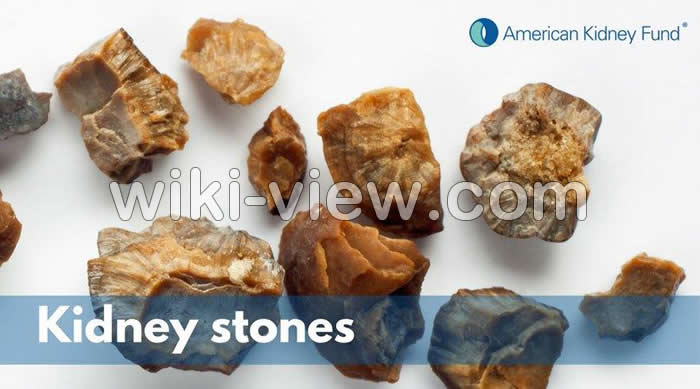 سنگ کلیه, سنگ کلیه چیست, علائم دقیق سنگ کلیه, انواع سنگ کلیه, اندازه سنگ کلیه, قرص دفع سنگ کلیه, علائم دفع سنگ کلیه, راه خانگی دفع سنگ کلیه, درمان سنگ کلیه بزرگ سنگ کلیه, سنگ کلیه چیست, علائم دقیق سنگ کلیه, انواع سنگ کلیه, اندازه سنگ کلیه, قرص دفع سنگ کلیه, علائم دفع سنگ کلیه, راه خانگی دفع سنگ کلیه, درمان سنگ کلیه بزرگ