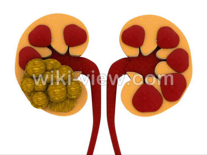 سنگ کلیه, سنگ کلیه چیست, علائم دقیق سنگ کلیه, انواع سنگ کلیه, اندازه سنگ کلیه, قرص دفع سنگ کلیه, علائم دفع سنگ کلیه, راه خانگی دفع سنگ کلیه, درمان سنگ کلیه بزرگ سنگ کلیه, سنگ کلیه چیست, علائم دقیق سنگ کلیه, انواع سنگ کلیه, اندازه سنگ کلیه, قرص دفع سنگ کلیه, علائم دفع سنگ کلیه, راه خانگی دفع سنگ کلیه, درمان سنگ کلیه بزرگ