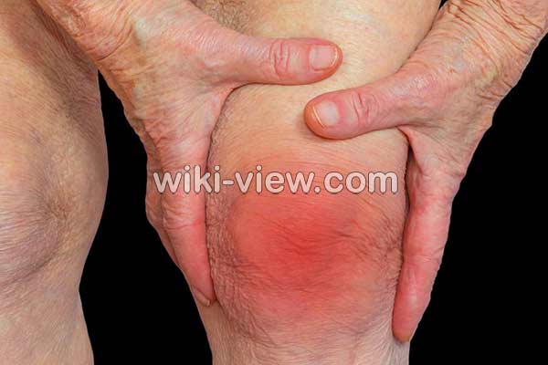 آرتریت, آرتریت چیست, علائم آرتریت, درمان آرتریت, عوارض آرتریت روماتوئید, آرتریت عفونی, آرتریت پا, درمان گیاهی آرتریت روماتوئید, آرتریت روماتوئید گردن, آرتریت روماتوئید جوانان, جدیدترین داروی آرتریت روماتوئید, درمان آرتریت روماتوئید در طب سنتی آرتریت, آرتریت چیست, علائم آرتریت, درمان آرتریت, عوارض آرتریت روماتوئید, آرتریت عفونی, آرتریت پا, درمان گیاهی آرتریت روماتوئید, آرتریت روماتوئید گردن, آرتریت روماتوئید جوانان, جدیدترین داروی آرتریت روماتوئید, درمان آرتریت روماتوئید در طب سنتی