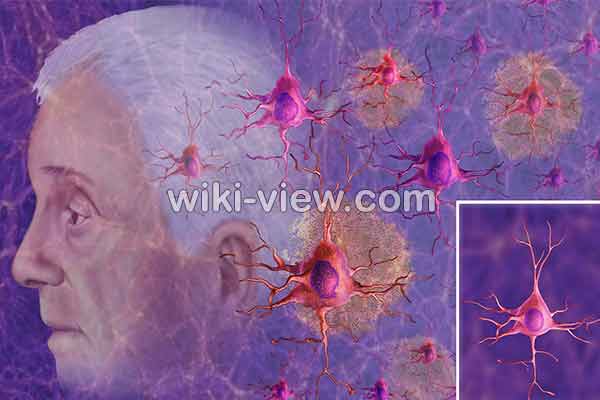 آلزایمر, علائم آلزایمر, علت آلزایمر, جدیدترین داروی آلزایمر, درمان آلزایمر در طب سنتی, پیشگیری از آلزایمر, آلزایمر در سالمندان, تست تشخیص آلزایمر, مرگ بیماران آلزایمری, علائم آلزایمر در جوانی, مراحل اخر الزایمر آلزایمر, علائم آلزایمر, علت آلزایمر, جدیدترین داروی آلزایمر, درمان آلزایمر در طب سنتی, پیشگیری از آلزایمر, آلزایمر در سالمندان, تست تشخیص آلزایمر, مرگ بیماران آلزایمری, علائم آلزایمر در جوانی, مراحل اخر الزایمر