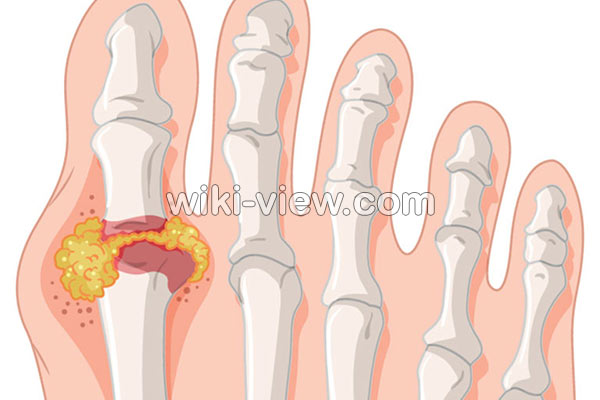نقرس, نقرس چیست, علائم نقرس, تشخیص نقرس, درمان نقرس, درمان نقرس در طب سنتی, نقرس پا, درمان دائمی نقرس, آیا نقرس خطرناک است, درمان نقرس با سماق نقرس, نقرس چیست, علائم نقرس, تشخیص نقرس, درمان نقرس, درمان نقرس در طب سنتی, نقرس پا, درمان دائمی نقرس, آیا نقرس خطرناک است, درمان نقرس با سماق