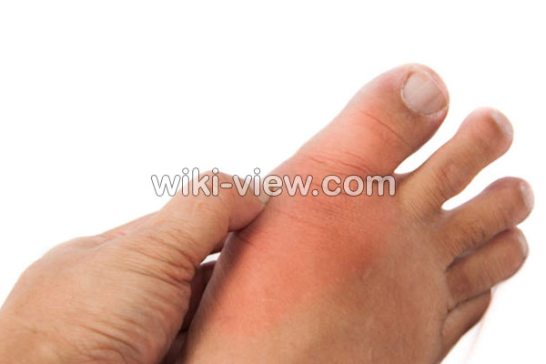 نقرس, نقرس چیست, علائم نقرس, تشخیص نقرس, درمان نقرس, درمان نقرس در طب سنتی, نقرس پا, درمان دائمی نقرس, آیا نقرس خطرناک است, درمان نقرس با سماق نقرس, نقرس چیست, علائم نقرس, تشخیص نقرس, درمان نقرس, درمان نقرس در طب سنتی, نقرس پا, درمان دائمی نقرس, آیا نقرس خطرناک است, درمان نقرس با سماق