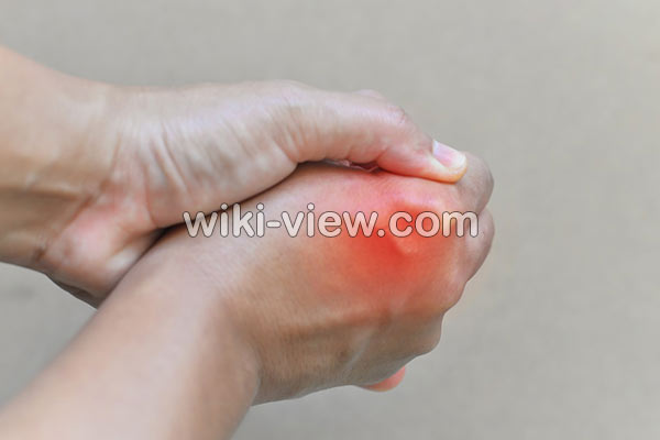 نقرس, نقرس چیست, علائم نقرس, تشخیص نقرس, درمان نقرس, درمان نقرس در طب سنتی, نقرس پا, درمان دائمی نقرس, آیا نقرس خطرناک است, درمان نقرس با سماق نقرس, نقرس چیست, علائم نقرس, تشخیص نقرس, درمان نقرس, درمان نقرس در طب سنتی, نقرس پا, درمان دائمی نقرس, آیا نقرس خطرناک است, درمان نقرس با سماق