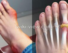 نقرس : علائم, تشخیص و درمان / درمان نقرس در طب سنتی با سماق / نقرس پا نقرس : علائم, تشخیص و درمان / درمان نقرس در طب سنتی با سماق / نقرس پا