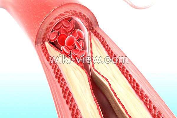 تصلب شرایین, تصلب شرایین چیست, علائم تصلب شرایین, تشخیص تصلب شرایین, درمان دارویی تصلب شرایین, درمان تصلب شرایین با طب سنتی, درمان تصلب شرایین پا, علائم تصلب شرایین مغز, درمان تصلب شرایین مغز تصلب شرایین, تصلب شرایین چیست, علائم تصلب شرایین, تشخیص تصلب شرایین, درمان دارویی تصلب شرایین, درمان تصلب شرایین با طب سنتی, درمان تصلب شرایین پا, علائم تصلب شرایین مغز, درمان تصلب شرایین مغز