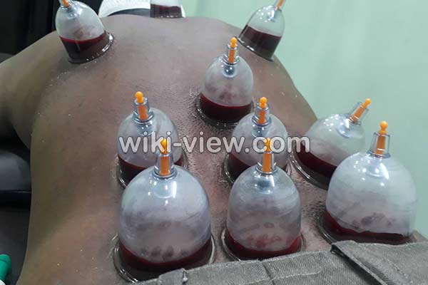 حجامت, حجامت چیست, حجامت فواید, ضرر حجامت, خطرات حجامت, روش حجامت, زمان حجامت, حجامت عام, حجامت کبد, حجامت سر, تقویم حجامت ۹۸, تقویم حجامت 99 حجامت, حجامت چیست, حجامت فواید, ضرر حجامت, خطرات حجامت, روش حجامت, زمان حجامت, حجامت عام, حجامت کبد, حجامت سر, تقویم حجامت ۹۸, تقویم حجامت 99
