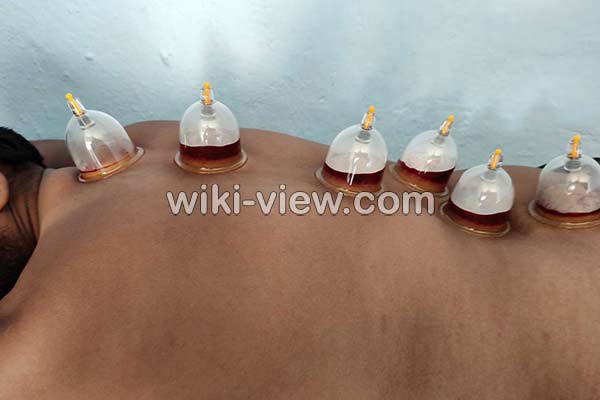 حجامت, حجامت چیست, حجامت فواید, ضرر حجامت, خطرات حجامت, روش حجامت, زمان حجامت, حجامت عام, حجامت کبد, حجامت سر, تقویم حجامت ۹۸, تقویم حجامت 99 حجامت, حجامت چیست, حجامت فواید, ضرر حجامت, خطرات حجامت, روش حجامت, زمان حجامت, حجامت عام, حجامت کبد, حجامت سر, تقویم حجامت ۹۸, تقویم حجامت 99