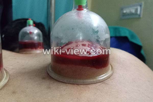 حجامت, حجامت چیست, حجامت فواید, ضرر حجامت, خطرات حجامت, روش حجامت, زمان حجامت, حجامت عام, حجامت کبد, حجامت سر, تقویم حجامت ۹۸, تقویم حجامت 99 حجامت, حجامت چیست, حجامت فواید, ضرر حجامت, خطرات حجامت, روش حجامت, زمان حجامت, حجامت عام, حجامت کبد, حجامت سر, تقویم حجامت ۹۸, تقویم حجامت 99