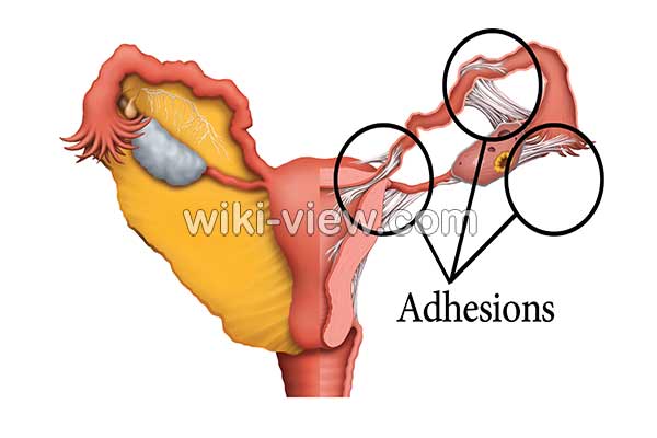 چسبندگی رحم, چسبندگی رحم چیست, علائم چسبندگی رحم, تشخیص چسبندگی رحم با سونوگرافی, درمان چسبندگی رحم, درمان چسبندگی رحم در طب سنتی, درمان چسبندگی رحم با عنبر نسارا, ایا چسبندگی رحم درد دارد, علائم چسبندگی رحم بعد از سزارین