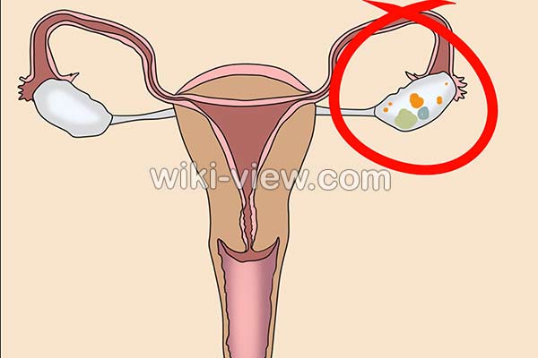 کیست تخمدان, علائم کیست تخمدان, درمان کیست تخمدان, درمان کیست تخمدان در طب سنتی, درمان کیست تخمدان با سیر, انواع کیست تخمدان, کیست تخمدان چیست, اندازه کیست تخمدان, جراحی کیست تخمدان, کیست تخمدان در دختر, علائم دفع کیست تخمدان, پارگی کیست تخمدان, کیست تخمدان چپ, کیست تخمدان به انگلیسی, اندازه کیست تخمدان, علائم کیست تخمدان در پریودی, درمان گیاهی کیست تخمدان
