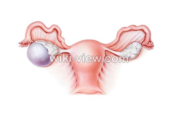 کیست تخمدان, علائم کیست تخمدان, درمان کیست تخمدان, درمان کیست تخمدان در طب سنتی, درمان کیست تخمدان با سیر, انواع کیست تخمدان, کیست تخمدان چیست, اندازه کیست تخمدان, جراحی کیست تخمدان, کیست تخمدان در دختر, علائم دفع کیست تخمدان, پارگی کیست تخمدان, کیست تخمدان چپ, کیست تخمدان به انگلیسی, اندازه کیست تخمدان, علائم کیست تخمدان در پریودی, درمان گیاهی کیست تخمدان