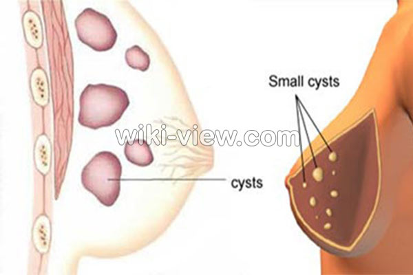 کیست سینه, کیست سینه چیست, علت به وجود آمدن کیست سینه, علائم کیست سینه, تشخیص کیست سینه, درمان کیست سینه با رازیانه, ویتامین ای در درمان کیست سینه, درمان کیست سینه با طب اسلامی, درمان کیست سینه در طب سنتی, درمان کیست سینه خیراندیش, درمان کیست سینه روازاده