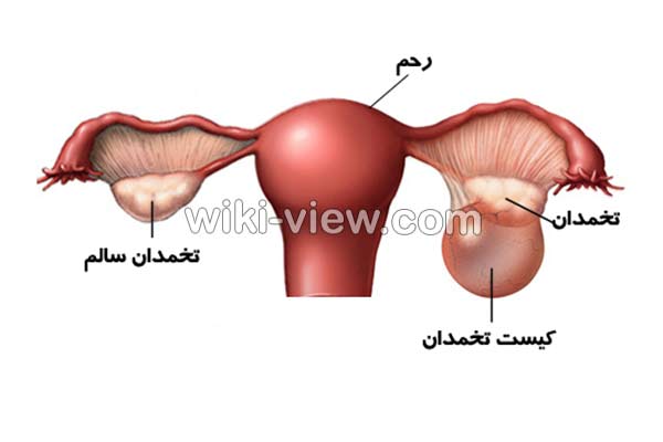 کیست تخمدان, علائم کیست تخمدان, درمان کیست تخمدان, درمان کیست تخمدان در طب سنتی, درمان کیست تخمدان با سیر, انواع کیست تخمدان, کیست تخمدان چیست, اندازه کیست تخمدان, جراحی کیست تخمدان, کیست تخمدان در دختر, علائم دفع کیست تخمدان, پارگی کیست تخمدان, کیست تخمدان چپ, کیست تخمدان به انگلیسی, اندازه کیست تخمدان, علائم کیست تخمدان در پریودی, درمان گیاهی کیست تخمدان