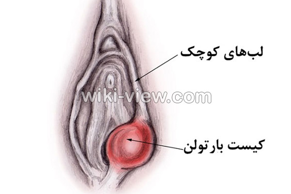 کیست بارتولن, کیست بارتولن چیست, علائم کیست بارتولن, تشخیص کیست بارتولن, درمان کیست بارتولن, درمان کیست بارتولن در طب سنتی, سفالکسین و کیست بارتولن, داروهای گیاهی برای کیست بارتولن, درمان کیست بارتولن باعسل, علائم ترکیدن کیست بارتولن, عوارض ترکیدن کیست بارتولن کیست بارتولن, کیست بارتولن چیست, علائم کیست بارتولن, تشخیص کیست بارتولن, درمان کیست بارتولن, درمان کیست بارتولن در طب سنتی, سفالکسین و کیست بارتولن, داروهای گیاهی برای کیست بارتولن, درمان کیست بارتولن باعسل, علائم ترکیدن کیست بارتولن, عوارض ترکیدن کیست بارتولن