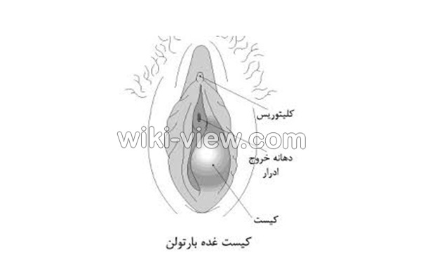کیست بارتولن, کیست بارتولن چیست, علائم کیست بارتولن, تشخیص کیست بارتولن, درمان کیست بارتولن, درمان کیست بارتولن در طب سنتی, سفالکسین و کیست بارتولن, داروهای گیاهی برای کیست بارتولن, درمان کیست بارتولن باعسل, علائم ترکیدن کیست بارتولن, عوارض ترکیدن کیست بارتولن کیست بارتولن, کیست بارتولن چیست, علائم کیست بارتولن, تشخیص کیست بارتولن, درمان کیست بارتولن, درمان کیست بارتولن در طب سنتی, سفالکسین و کیست بارتولن, داروهای گیاهی برای کیست بارتولن, درمان کیست بارتولن باعسل, علائم ترکیدن کیست بارتولن, عوارض ترکیدن کیست بارتولن