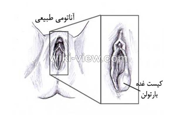 کیست بارتولن, کیست بارتولن چیست, علائم کیست بارتولن, تشخیص کیست بارتولن, درمان کیست بارتولن, درمان کیست بارتولن در طب سنتی, سفالکسین و کیست بارتولن, داروهای گیاهی برای کیست بارتولن, درمان کیست بارتولن باعسل, علائم ترکیدن کیست بارتولن, عوارض ترکیدن کیست بارتولن کیست بارتولن, کیست بارتولن چیست, علائم کیست بارتولن, تشخیص کیست بارتولن, درمان کیست بارتولن, درمان کیست بارتولن در طب سنتی, سفالکسین و کیست بارتولن, داروهای گیاهی برای کیست بارتولن, درمان کیست بارتولن باعسل, علائم ترکیدن کیست بارتولن, عوارض ترکیدن کیست بارتولن